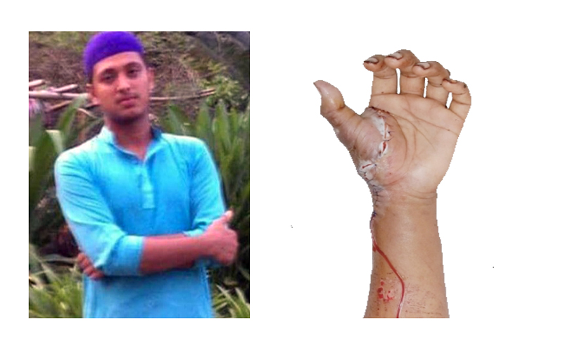 ওসমানী হাসপাতালের সাফল্যে বিশ্বনাথের মাদ্রাসা ছাত্র ইয়াছিন