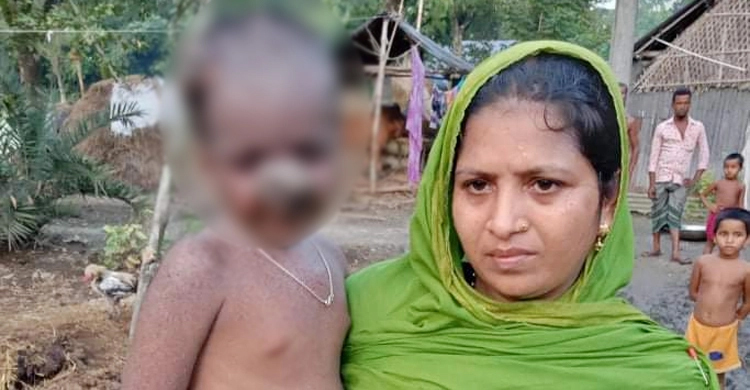 পচে যাচ্ছে শিশু সালমানের মাথা, অভাবে ঘর বিক্রি করে দিলেন বাবা-মা