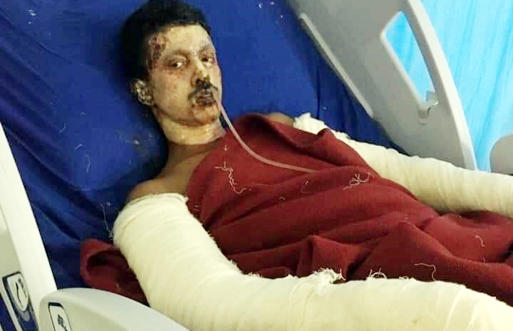 বিশ্বনাথে মা ও ভাইয়ের পর এবার মারা গেলেন অগ্নিদগ্ধ ফয়সল