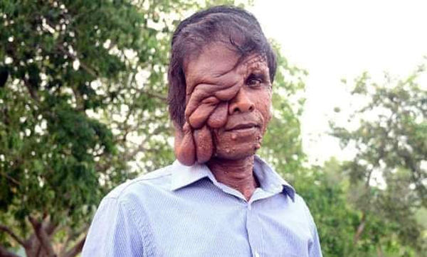চার সন্তানের জন্য বাঁচতে চান বিরল রোগে আক্রান্ত বিশ্বনাথের জিলু মিয়া